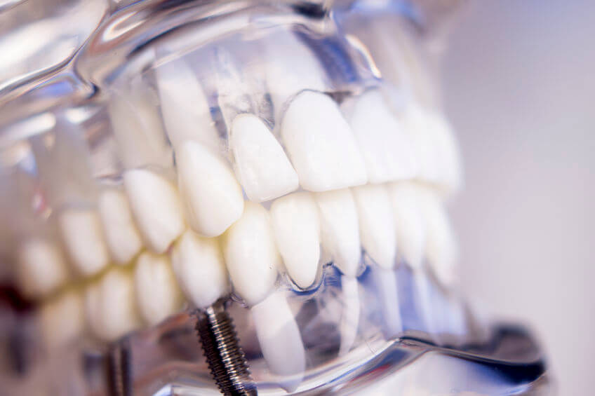 Dental implants Carrollton